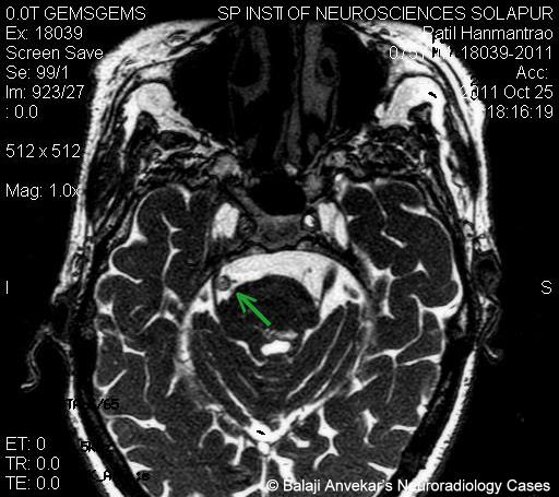 Does plan? Compressed facial nerve Absolutely Compressed facial nerve have